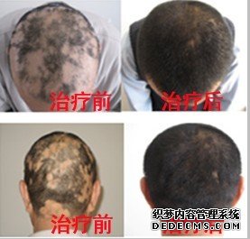 宁波海曙摩范皮肤专科医院斑秃案例